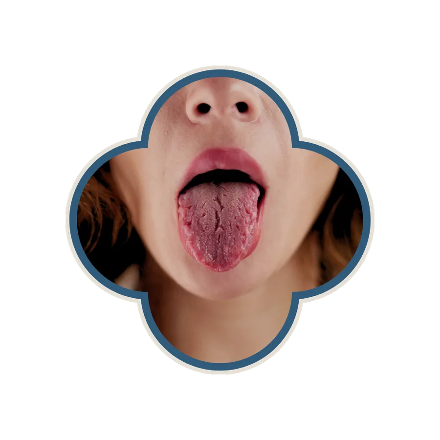 Tongue diagnosis in Chinese medicine