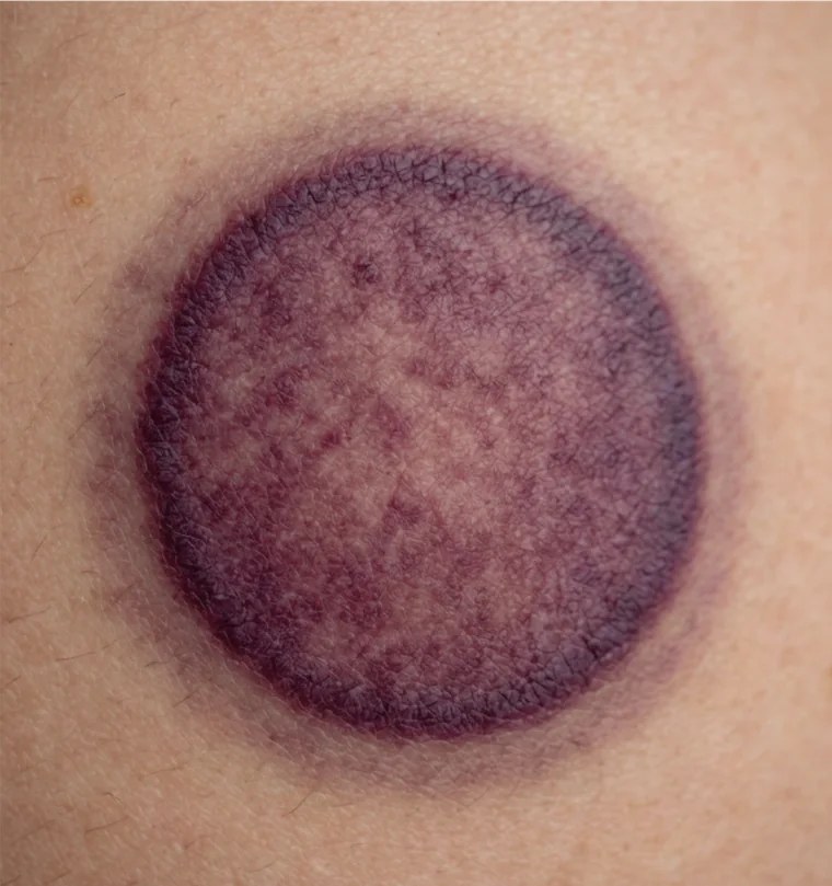 A deep purple cupping mark on skin