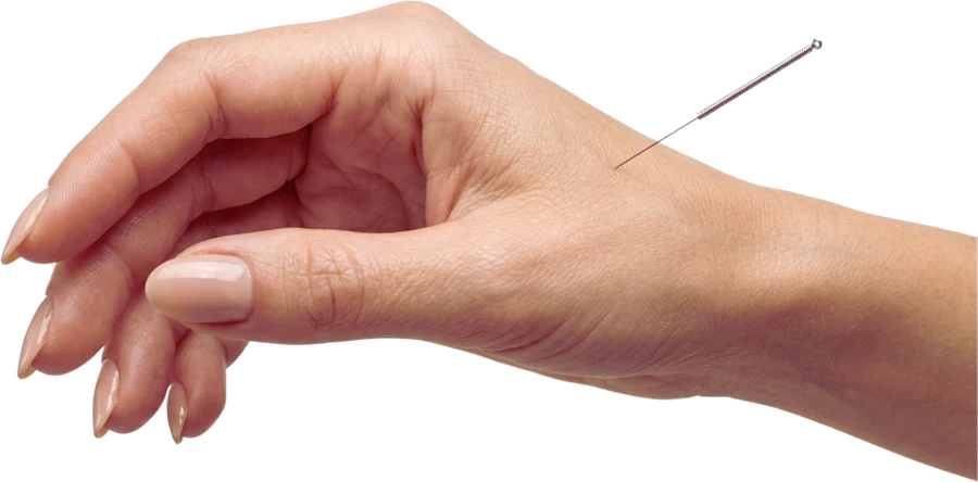 A single acupuncture needle inserted into the back of a hand