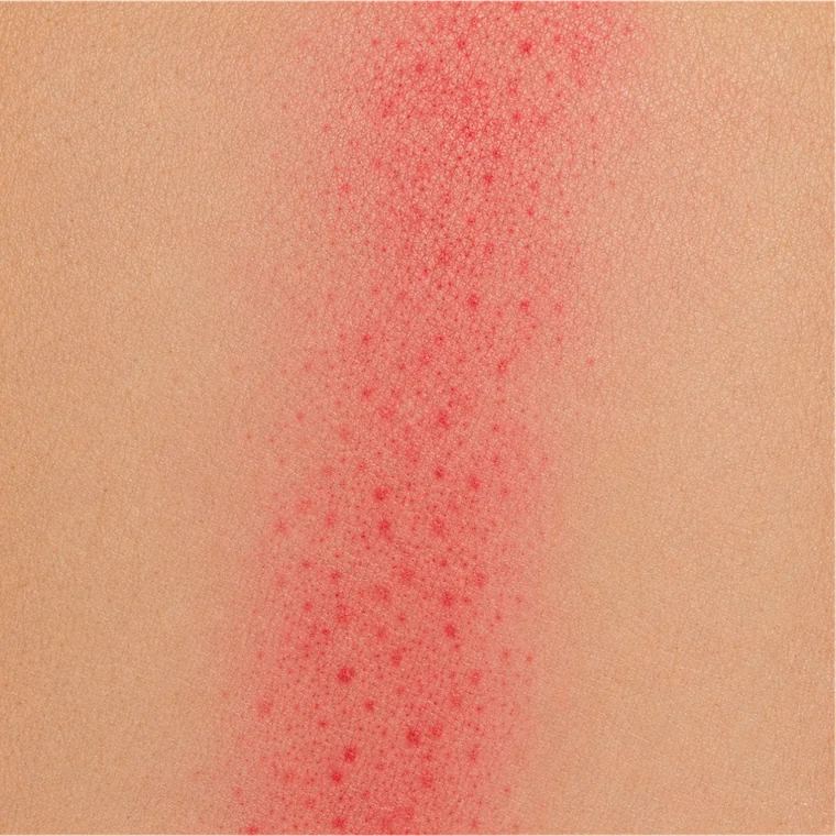 Sha - fine red petechiae raised along a stroke line on the skin